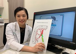 微創右結腸全腸系膜及D3淋巴結廓清手術  傷口小恢復快完整切除