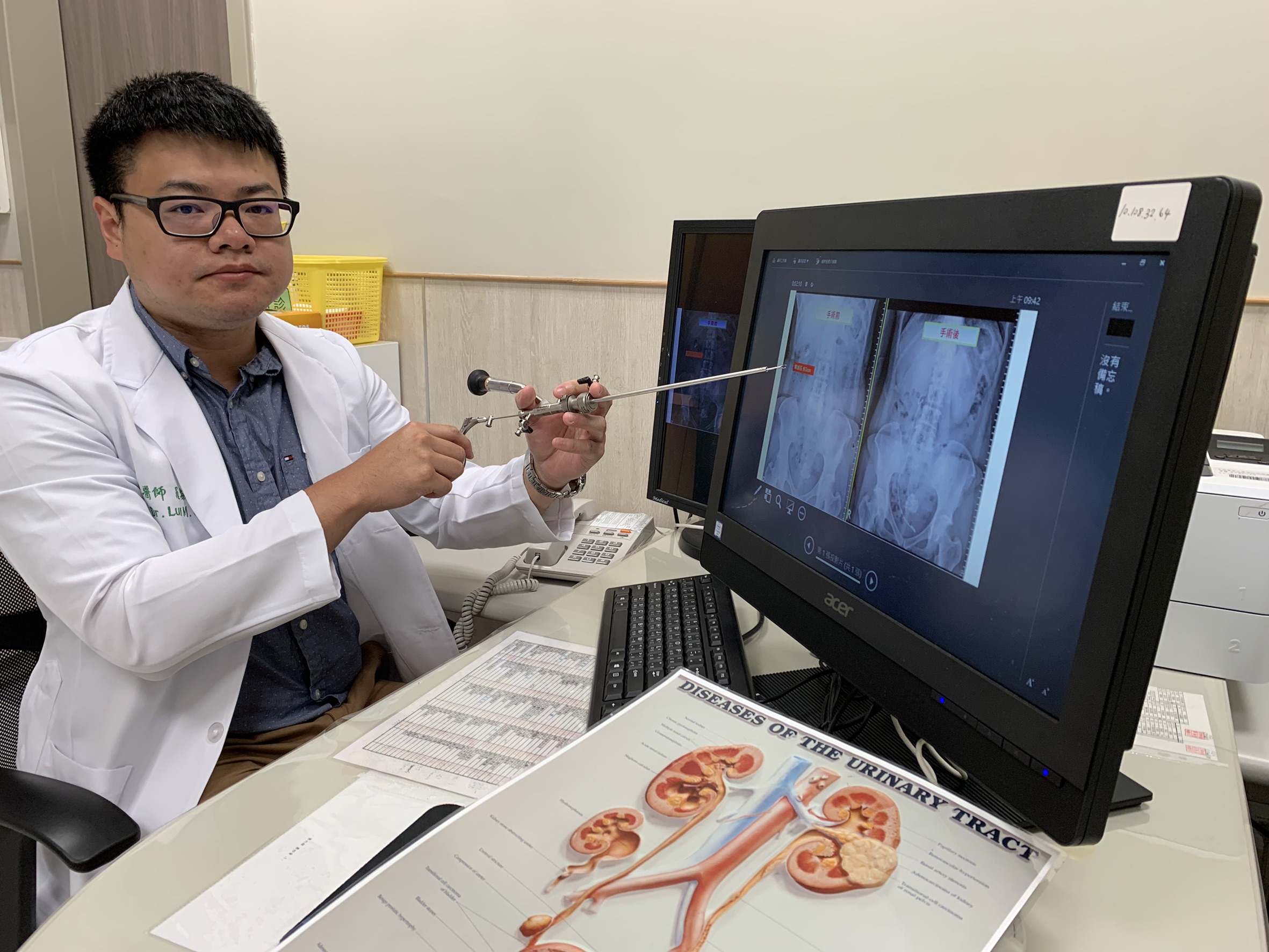 一階段「迷你腎臟鏡碎石手術」約0.6公分傷口無石一身輕