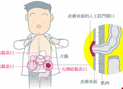 腸造口併發症的處理 (一)