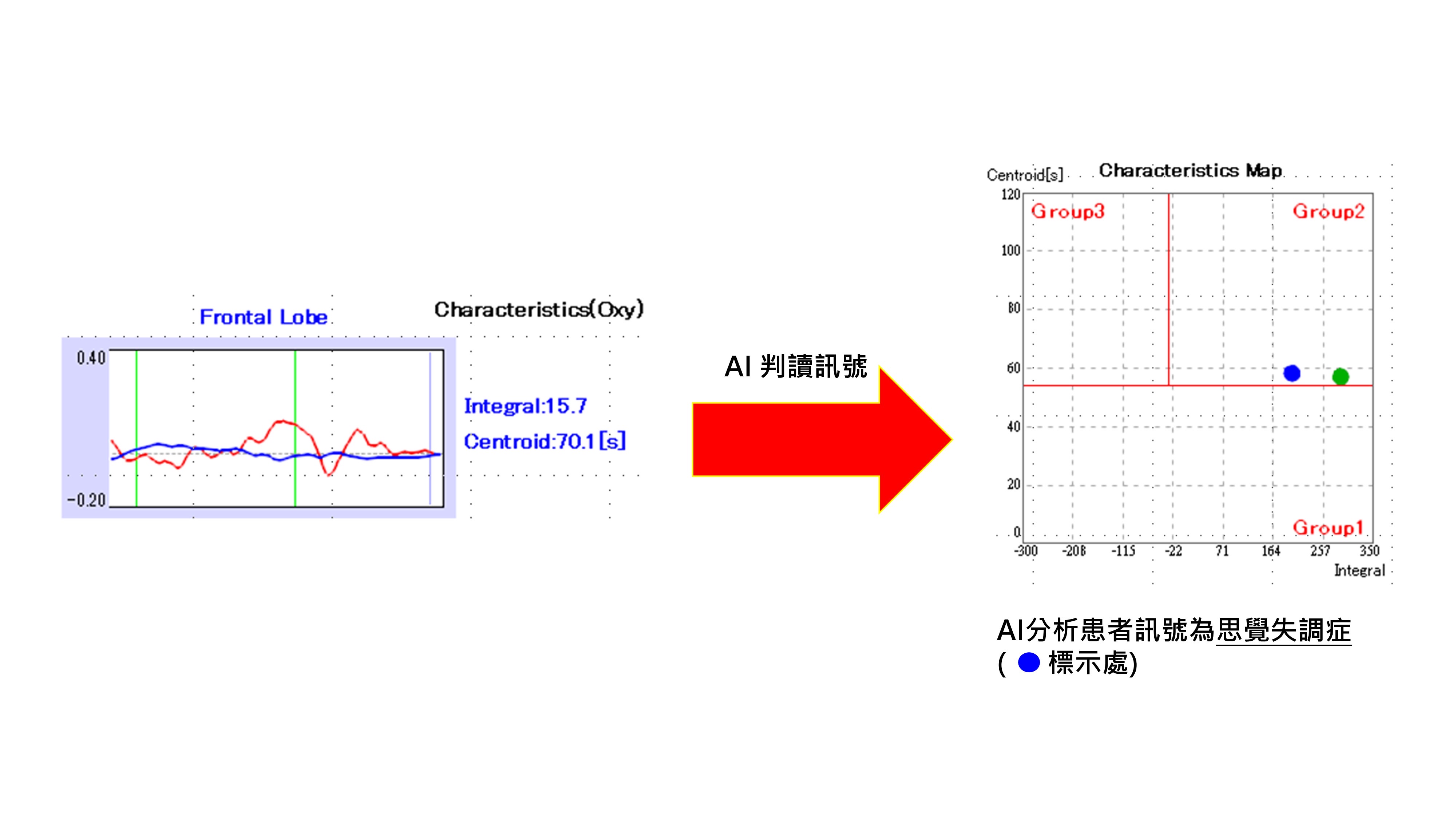 腦功能檢查合併新創AI技術　協助醫師精準評估憂鬱症