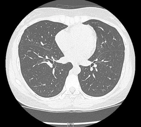 低劑量肺部電腦斷層掃描