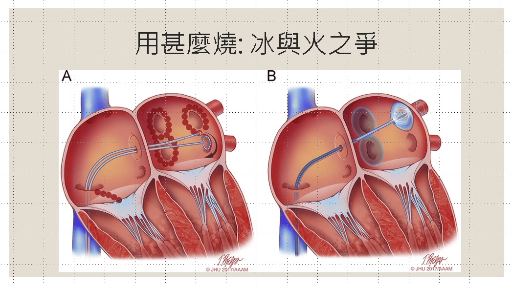 冷凍消融術