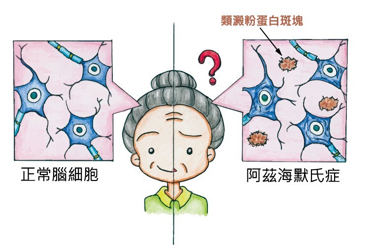 類澱粉蛋白斑塊