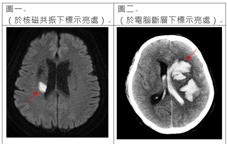 左半邊圖片：於核磁共振下標示亮處；右半邊圖片：於電腦斷層下標示亮處