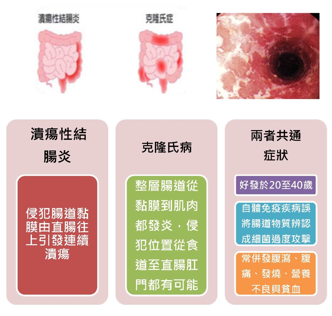 大腸直腸外科| 發炎性腸道疾病- 中國醫藥大學新竹附設醫院