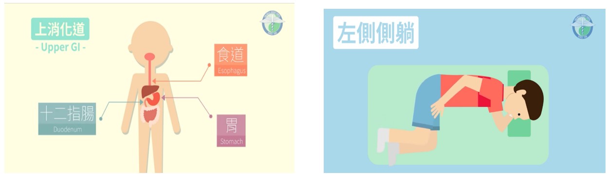 上消化道、左側側躺示意圖